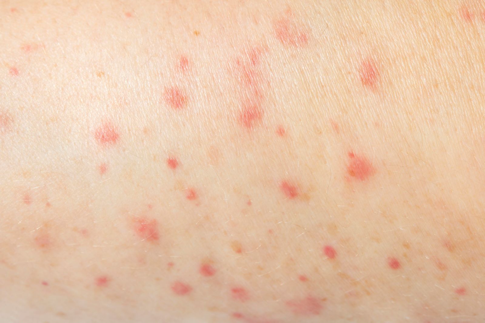 person-having-skin-allergy-close-up_1.jpg