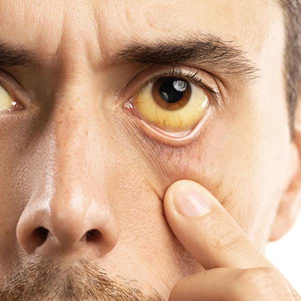 Julho Amarelo: Saúde alerta para a conscientização e combate às hepatites virais