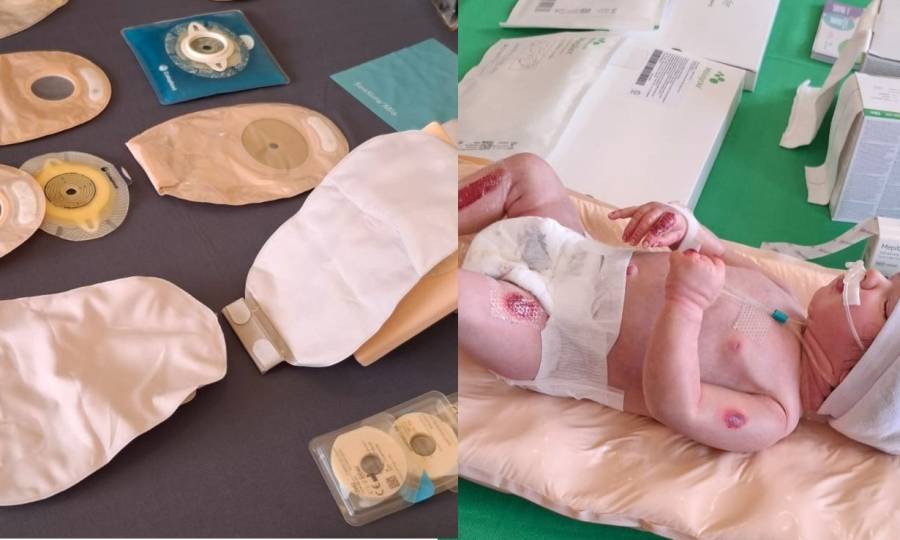 Saúde SC abre inscrições para capacitação de profissionais no atendimento de pessoas com Estomias e Epidermólise Bolhosa em Lages