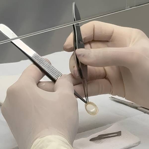 Banco de Olhos garante qualidade dos tecidos oculares doados em Santa Catarina