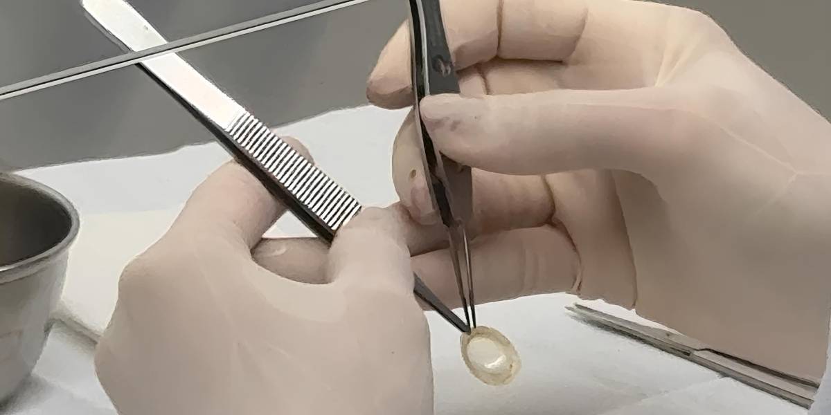 Banco de Olhos garante qualidade dos tecidos oculares doados em Santa Catarina