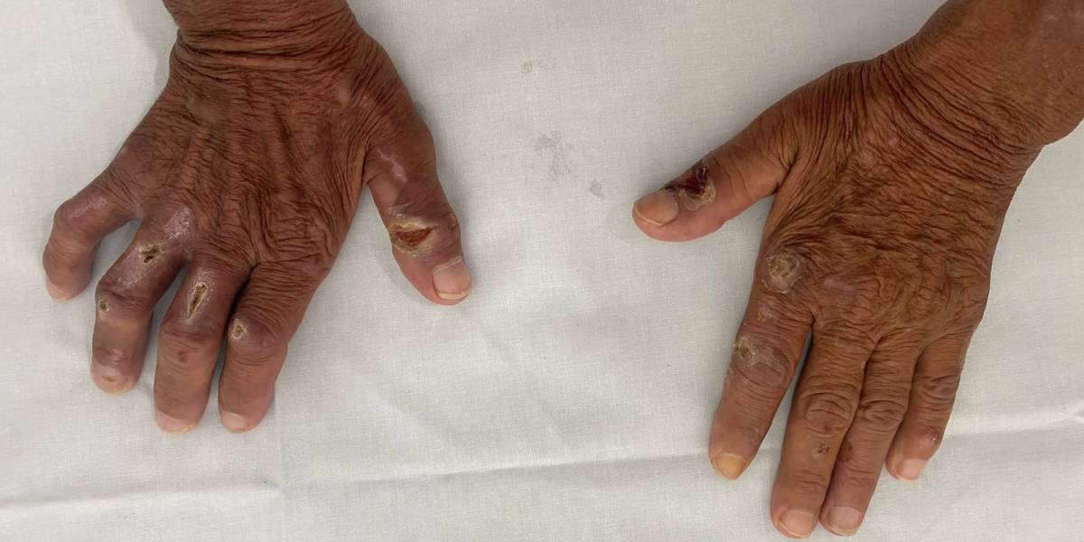 Dia de Combate e Prevenção à Hanseníase reforça importância do diagnóstico precoce e do enfrentamento ao estigma