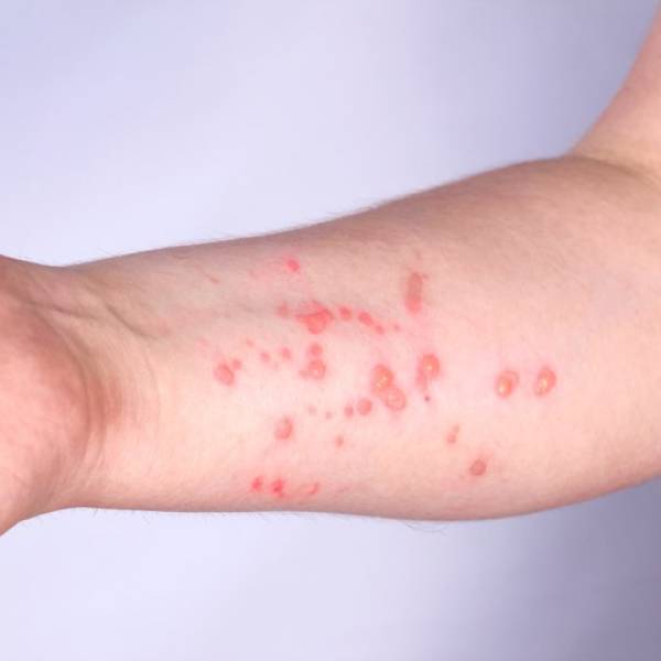 Santa Catarina segue sem casos de Mpox e Saúde Estadual reforça orientações