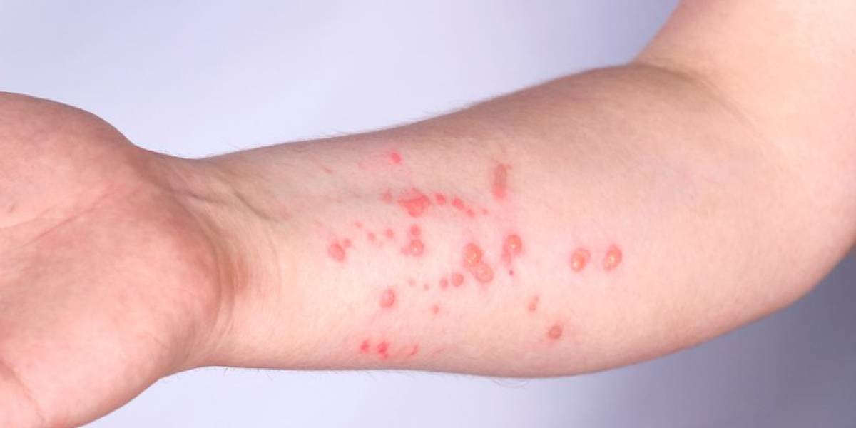 Santa Catarina segue sem casos de Mpox e Saúde Estadual reforça orientações