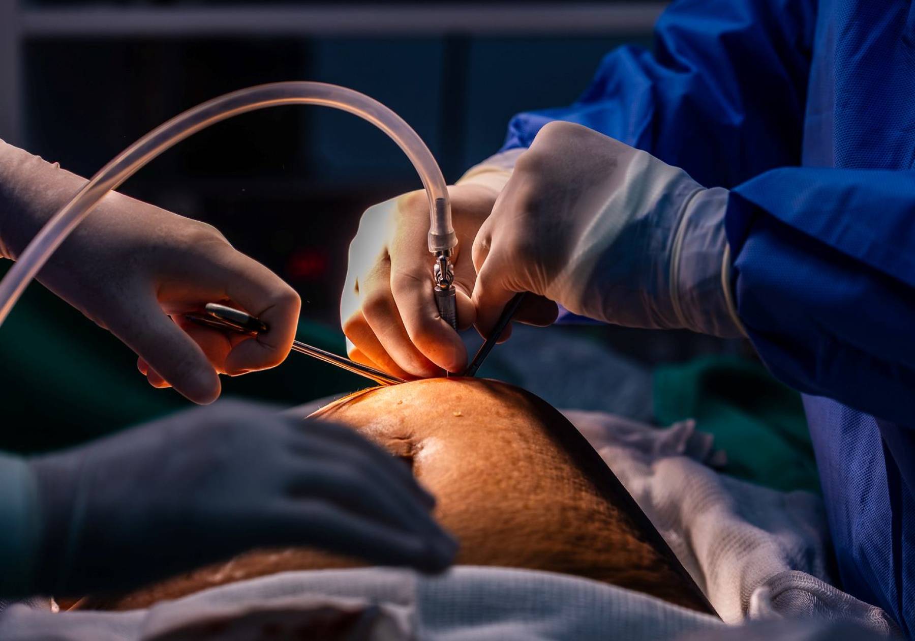 Governo do Estado aprova ampliação do acesso a cirurgias bariátricas no Hospital Bethesda, em Joinville